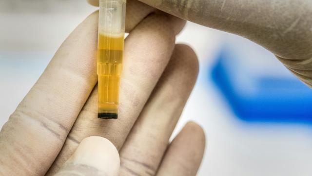 Vi søker urinprøver til prosjekt Cystinuri